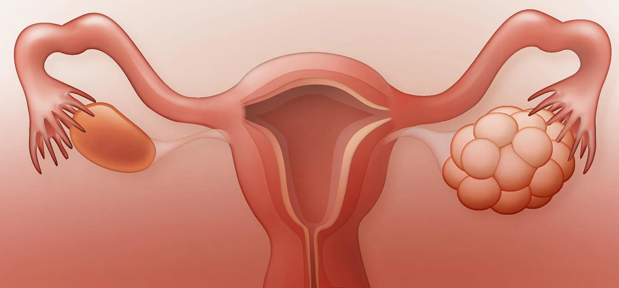 What is PCOS?
